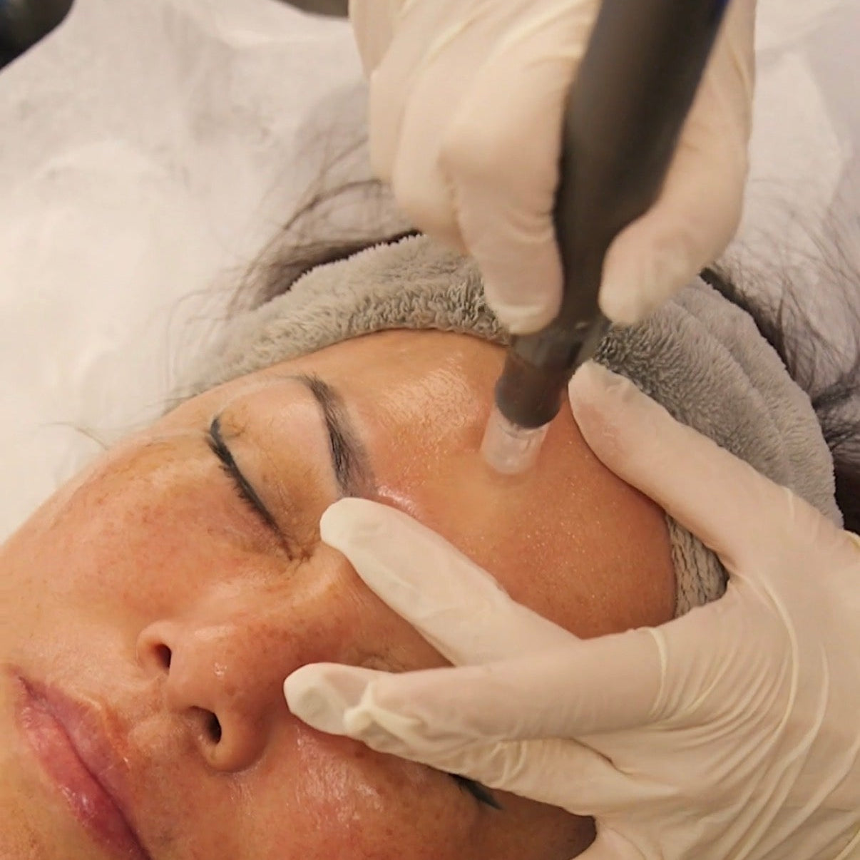 Exosome Microneedling